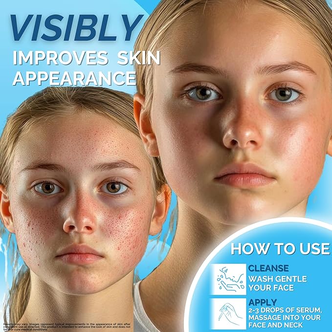 Spotless Serum - Vitamin C Serum for Dark Spots with Niacinamide 5%, Korean Skin Care, Proactive Acne Treatment For Face, Hyaluronic Acid Hydration, Soothing Turmeric & Centella Asiatica, 1fl oz