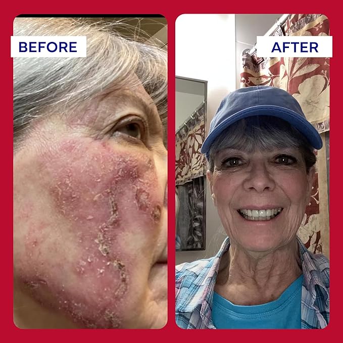 emuaid EMUAIDMAX Ointment for Itchy Skin, Maximum Strength Treatment for Athlete's Foot, Psoriasis, Jock Itch, Rash, Eczema, Cold Sores, Blisters, and Yeast Infection 2oz