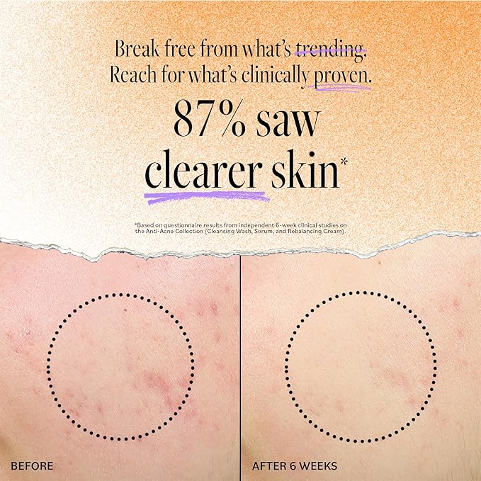 Derma E Acne Deep Pore Cleansing Wash – Blemish Control Facial Cleanser with Salicylic Acid - Gentle Oil Control Face Wash Soothes and Balances Skin, 6 fl oz