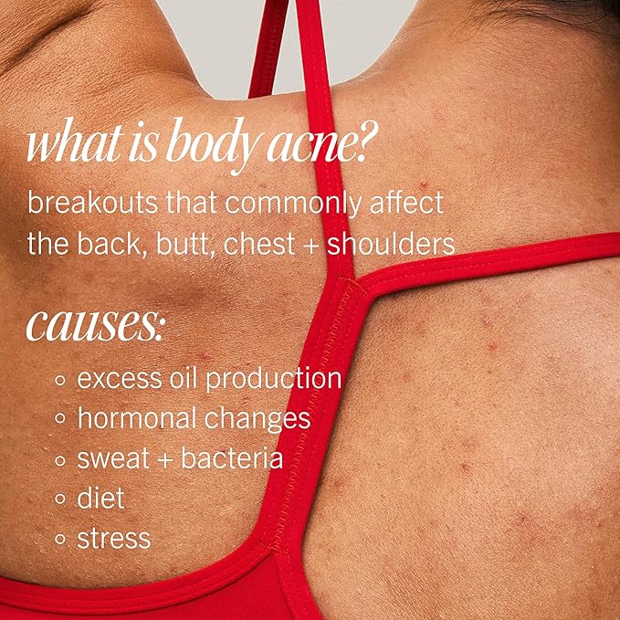 First Aid Beauty Body Acne Spray - Maximum Strength Body Acne Treatment With 360-Degree Sprayer - 2% Salicylic Acid Formula, (3.0 oz)